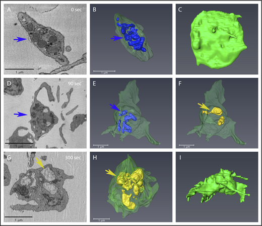 Figure 3. Condensed and decondensed α-granules distribution remains predominantly central during shape change in stimulated platelets. Each row shows various views of the same platelet. (A,D,G) Individual slices from SBF-SEM image stacks showing changes in platelets at various times of stimulation. Blue arrows indicate condensed granules; tan/yellow arrows indicate decondensed granules. (B,E,H) Condensed granules are rendered in blue, and decondensed granules in tan/yellow. (C,F,I) PM is rendered in green. A decondensed granule appeared to be connected to the PM via a long pipe as shown in panel F. Supplemental Figure 3 Movie shows the 90 seconds rendered example rotated in 3-dimensional space. α-Granule surface area and sizes were quantified from similar renderings for multiple randomly chosen platelets (see Figure 4 for additional examples), and the quantitation of their characteristics is reported in Tables 1 and 2.