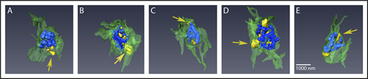 Figure 4. Peripheral α-granules appear to decondense first upon stimulation. Renderings from SBF-SEM of 5 different platelets, stimulated for 90 seconds (A-E) are shown. Condensed granules are rendered in blue, decondensed granules are rendered in tan/yellow, and PM is rendered in green. Arrows point to examples of peripherally located, decondensed granules. Quantification of granule sizes is tabulated in Table 1. Bar represents 1 μm.