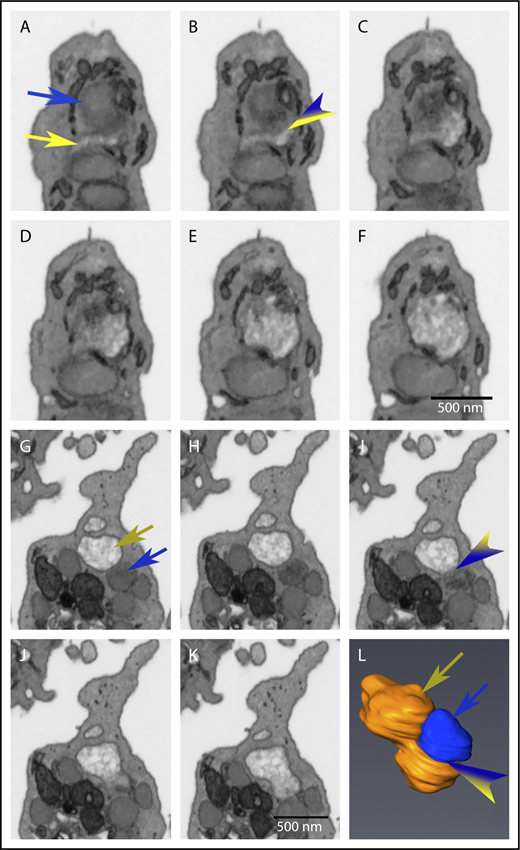Figure 5. α-Granule matrix decondensation propagates from open canalicular system–granule fusion or decondensed-condensed granule fusion sites. Images are individual slices from FIB-SEM image stacks, and the frames shown are spaced 15 nm apart. (A-F) The blue arrow indicates a condensed α-granule, and the yellow indicates open canalicular system–elements (A). The variegated blue/yellow arrowhead indicates a CS-granule fusion zone (B). The dark tubular structures adhering to the decondensing α-granule are elements of dense tubular network. (G-L) The tan arrow indicates a decondensed α-granule (G), and the blue arrow indicates a condensed α-granule (G). The variegated tan/blue arrowhead indicates the decondensed-condensed granule fusion zone in the FIB-SEM slice (I) and similarly marks the fusion zone in a rendering (L) that is slightly tilted from the perpendicular relative to the FIB-SEM image planes. Bars represent 0.5 μm.