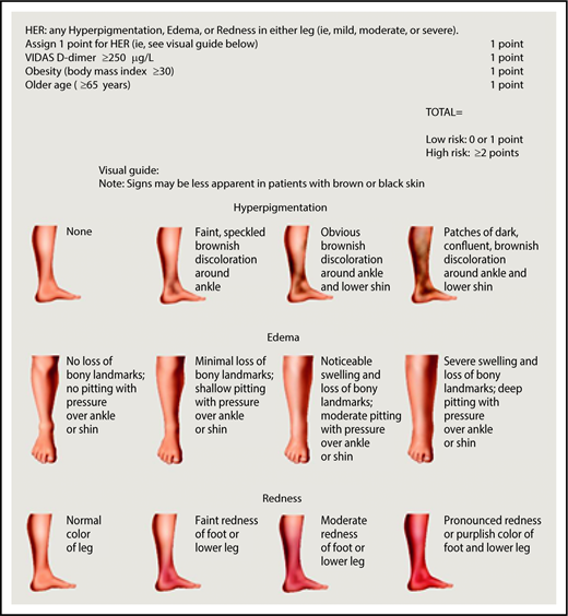 Figure 2. HERDOO2 score to identify low-risk women with unprovoked or weakly provoked VTE who can discontinue anticoagulants after short-term therapy (reproduced from Rodger et al30 with permission).