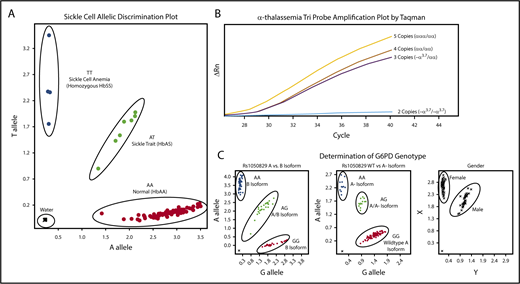 Figure 1. Molecular determination of sickle cell, α-thalassemia, and G6PD status. Each panel represents example allelic discrimination (A,C) or probe amplification (B) plots for the reverse transcriptase-PCR assays used to determine each blood disorder. (A) Molecular determination of the presence of absence of the HbS mutation. (B) Probe amplification plots by α-globin genotype, demonstrating later probe amplification with each α-globin gene deletion. (C) Allelic discrimination plot to determine G6PD A vs B isoforms, the presence or absence of the A− isoform, and a confirmatory sex assay to identify male and female samples.