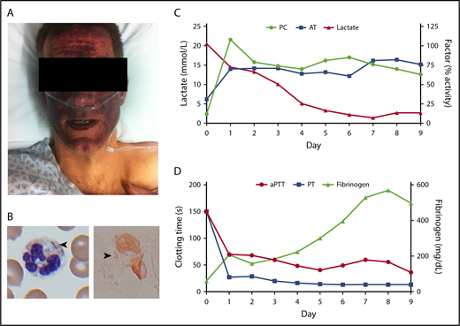 Figure 1. Initial presentation and clinical course. (A) The patient as he appeared at presentation, following rapid development of a mask-like purpuric rash involving the face. (B) Polymorphonuclear leukocyte containing rod-like basophilic inclusions on Wright’s stain (arrowhead; left panel), and Gram’s stain (arrowhead; right panel). Original magnification ×1000. (C) Plasma levels of PC, antithrombin (AT), and lactate during the first 10 days of hospitalization. (D) Activated partial thromboplastin time (aPTT), prothrombin time (PT), and fibrinogen during the same period. PC and antithrombin concentrates were administered twice daily starting 6 hours after presentation through day 10 of hospitalization.