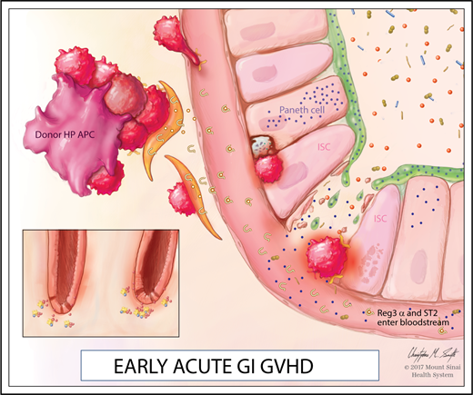 Figure 1. Early acute GI GVHD. At steady state, ISCs and Paneth cells are adjacent at the base of the intestinal crypts. Homeostasis is maintained, in part, by large numbers of commensal bacteria that stimulate IL-22 production by ILC3s. During GVHD, activated donor T cells recognize histocompatibility antigens on both hematopoietic (HP) and nonhematopoietic antigen-presenting cells (APCs). Activated APCs and T cells trigger the release of alarmins, such as IL-33, that bind to its receptor ST2; soluble ST2 (both bound to IL-33 and unbound) can enter the villus capillaries. Activated donor T cells destroy ILC3s, Paneth cells, and ISCs, releasing REG3A that was stored in the mucus and Paneth cells into the bloodstream as the epithelial barrier is breached.