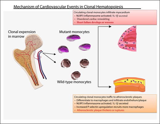 Figure 1. Probable mechanism of cardiovascular injury associated with clonal hematopoiesis. Mutant HSC-derived monocytes circulate and are recruited to plaques in arteries. There, they differentiate into tissue macrophages, which promote inflammation. The inflammasome activates IL-1β, which, in turn, promotes local inflammation, accelerating atherosclerosis, as well as induces expression of the P-selectin glycoprotein, which, in turn, recruits more monocytes (clonally derived and wild-type). Clonally derived platelets may also play an important role. In addition, increased interleukin-1β secretion in endothelial cells within the myocardium promotes disordered remodeling that potentiates heart failure.