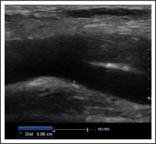 Figure 1. B-mode longitudinal axis image of the CFA at its point of bifurcation. The measurement point on its far wall for IMT is denoted by the cursors (6 mm in this patient). Dist, distance.