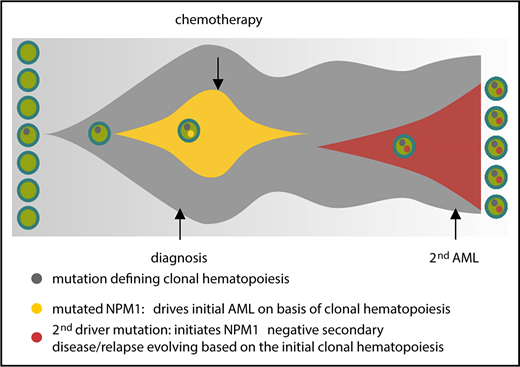 Figure 6. Model for clonal hematopoiesis driving relapse or secondary leukemia. The first leukemia is cured by chemotherapy based on the underlying clonal hematopoiesis; a second driver mutation than leads to overt relapse.