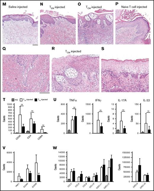 Human TCMhave potent effector functions, home to skin, and induce dermatitis in human engrafted mice. (A,F) Both CD4+ and CD8+ TCM produced T-cell signature inflammatory cytokines. Cytokine production was assayed by CyTOF following stimulation with phorbol 12-myristate 13-acetate/ionomycin. Production of TH1/TC1 (IFN-γ), TH2/TC2 (IL-4, IL-13), TH17/TC17 (IL-17A), TH22/TC22 (IL-22) signature cytokines by TCM and TEM is shown. Figures represent the mean of 6 donors. (B,G) Total production of signature cytokines by TCM (white bars) compared with TEM from the same donors (black bars) for (B) CD4+ and (G) CD8+ T cells. (C-E,H-J) Production of IL-2, TNF-α, and IL-10 by (C-E) CD4+ and (H-J) CD8+ T cells is shown. The mean and SEM of 6 donors are shown. (K-W) Human TCM home to skin and induce an inflammatory dermatitis comparable to TEM in human engrafted mice. (K) The human engrafted mouse experimental model. (L-P) Hematoxylin and eosin evaluation of human skin grafts 3 weeks after injection of (L-M) saline, (N) TEM, (O) TCM, or (P) naive T cells. TCM homed to human skin grafts and induced T-cell–mediated inflammatory dermatitis. (P) Injection of naive T cells led to minimal inflammation. (Q-S) The inflammatory patterns induced by purified TCM included (Q) interface dermatitis, (R) spongiotic dermatitis, and (S) epidermal necrosis. Results shown are representative of those obtained with 6 different human blood cell donors. (T) T-cell migration into the skin as assessed by NanoString CD3/CD4/CD8 gene expression analysis was comparable in TCM- and TEM-injected mice. (U-V) The production of inflammatory T-cell cytokines in skin (TNF-α, IFN-γ, IL-17A, and IL-22) and cytotoxic effector molecules (PRF1, perforin; GZMA, granzyme A; GZMB, granzyme B) was comparable in TCM- and TEM-injected mice. (W) Production of inflammatory chemokines in skin was comparable in TCM- and TEM-injected mice. For panels T-W, the mean and SEM of messenger RNA copies detected by NanoString analyses from 6 different human TCM/TEM donors are shown. Scale bars, 100 μm. GVHD, graft-versus-host disease; NS, normal skin; ns, not significant.