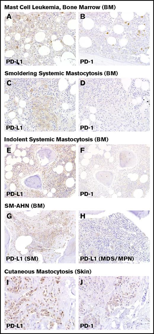 Figure 1. Immunohistochemical staining of PD-L1 and PD-1 in mastocytosis. Immunohistochemical expression of PD-L1 is shown at left for (A) MCL, (C) smoldering SM, (E) ISM, (G) SM-AHN (MDS/MPN), and (I) CM. At right, immunohistochemical staining for PD-1 is shown for (B) MCL, (D) smoldering SM, (F) ISM, and (J) CM. (G-H) In SM-AHN (MDS/MPN), the PD-L1 expression is restricted to the MC component as shown in panel G, but it is not present in the associated hematologic neoplasm as shown in panel H. Magnification ×40 in panels A-D,I-J and ×20 in panel E-H. Images taken with an Olympus BX41 microscope with Olympus cellSens standard version 1.14 software, and standard color balancing and image sizing using Adobe Photoshop.