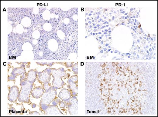 Figure 2. Immunohistochemical staining of PD-L1 and PD-1 in healthy BM and controls. (A) IHC for PD-L1 showed no staining in healthy or reactive BM. (B) Staining of healthy and reactive BM with antibody against PD-1 is generally negative with a rare lymphocyte showing membranous staining. (C) Strong staining of placental syncytiotrophoblasts is shown with antibody against PD-L1. (D) Staining of tonsil with antibody against PD-1 highlights a subset of T cells in the germinal center, as shown at right. Magnification ×40 in panels A,C-D and ×100 in panel B. Images taken with an Olympus BX41 microscope with Olympus cellSens standard version 1.14 software, and standard color balancing and image sizing using Adobe Photoshop.
