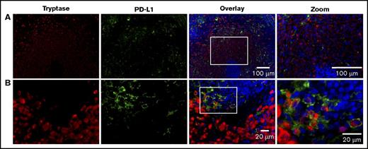 Figure 4. Expression of PD-L1 occurs on MCs in MCL. Splenic tissue from a patient with MCL was stained for MCs (tryptase, red), PD-L1 (light green), and nuclei (DAPI, blue). (A) Image acquired at ×20 magnification. Scale bars, 100 µm. Note the MC nest localized around the PALS. (B) Image acquired at ×63 magnification. Scale bars, 20 µm. White boxes in overlay image denote the region magnified in the right column. The coexpression of PD-L1 and tryptase in MCs is demonstrated at high power, however, only a subset of MCs is positive for PD-L1. Smaller numbers of PD-L1+ cells lacking tryptase coexpression are also seen at the edge of MC infiltrates.