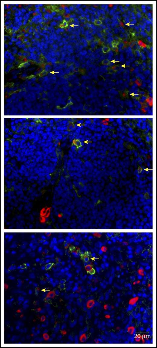 Figure 5. Further examples of tryptase (red) and PD-L1 (light green) coexpression on MCs in spleen from a MCL patient. Cell nuclei are blue (DAPI). Images acquired at 60× magnification. Scale bar, 20 μm. Coexpression is indicated by yellow arrows. A subset of MCs lacking PD-L1 expression is noted. Small numbers of PD-L1+ cells lacking tryptase expression are also present.