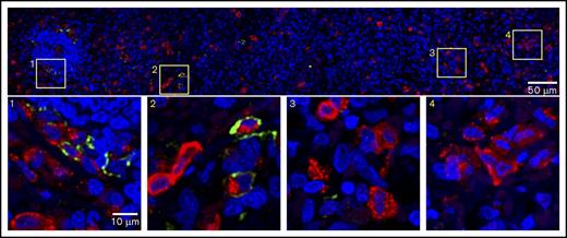 Figure 6. PD-L1–coexpressing MCs aggregate near the PALS structure in MCL. Splenic tissue was stained for expression of tryptase (red), PD-L1 (light green), and nuclei (DAPI, blue). (Top panel) Seven regions of interest acquired by confocal microscopy were stitched together to provide a larger field of view. Images are the maximum projection of 3 z-sections. Total field of view is 184.52 µm × 1290.24 µm; scale bar, 50 µm. (1-4) Magnification of corresponding boxes in top panel. Scale bar, 10 µm. Note that PD-L1+ MCs are more frequently found near the PALS.