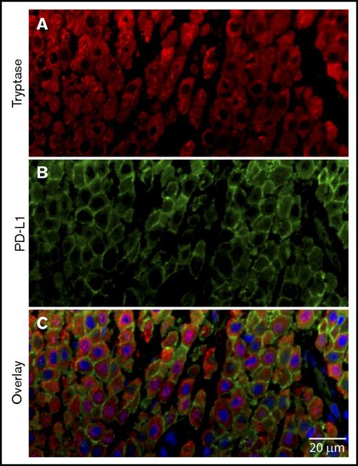 Figure 7. PD-L1+ MCs in CM. Skin biopsy from a patient with CM was stained for expression of (A) tryptase (red), (B) PD-L1 (light green), and (C) nuclei (DAPI, blue). Scale bar, 20 µm. The majority of MCs show PD-L1 membrane labeling.