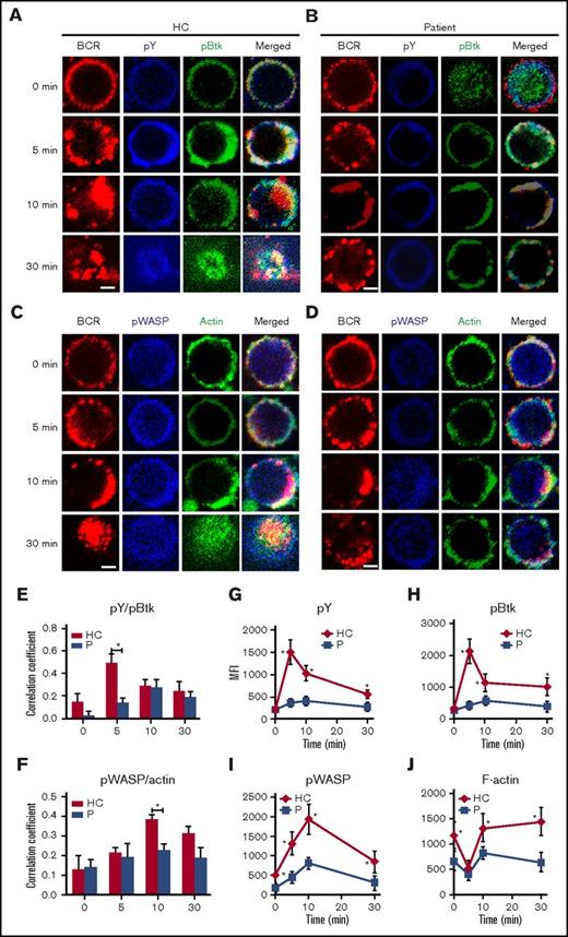 Figure 5. The recruitment of BCR signalosomes and actin to BCR clusters is decreased in Dock8 patients. Human B cells from HCs and Dock8 patients were incubated with AF546–mB-Fab′–anti-Ig without or with streptavidin (sAg) at 4°C, washed, and warmed to 37°C for varying lengths of time. After fixation and permeabilization, the cells were stained for pY, pBtk, pWASP, and F-actin and were analyzed using CFm (A-D) or flow cytometry (G-J). The Pearson’s correlation coefficients between BCR and pY/pBtk (E) or between BCR and pWASP/actin (F) staining in sAg-stimulated cells were determined using NIS-Elements AR 3.2 software. Flow cytometry analysis of the MFI of pY (G), pBtk (H), pWASP (I), and F-actin (J) after stimulation with sAgs. Shown are representative images in which more than 50 cells were individually analyzed using NIS-Elements AR 3.2 software, and mean values (±SD) are from 3 independent experiments. All 3 patients were included, and each patient was an independent experiment. Scale bars, 2.5 μm. *P < .01. P, probability.