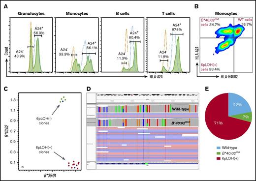 Figure 1. Establishment of iPSCs with different HLA genotypes from the monocytes of a patient with acquired AA. (A) HLA-A*24:02–lacking cells in the different lineages of cells. Histograms of HLA-A*24:02-expressing cells in different lineages of the patient (green lines) and a healthy individual (blue lines) are shown. (B) HLA-B4002 expression in monocyte fractions of the patient. Three different populations including A24+B4002+ (WT), A24+B4002− (B*40:02mut), and A24−B4002− (6pLOH+) monocytes are shown. (C) Results of TaqMan PCR on 14 iPSC clones showing 10 6pLOH+ iPSC clones (red dots) and 4 6pLOH− iPSC clones (green dots) that include 1 B4002− clone; the blue dots represent control DNA. The x-axis and y-axis represent the amplified product amounts of B*40:02 and B*35:01, respectively. (D) Next-generation sequencing findings for B4002− iPSC clone G2 showing a start loss mutation in B*40:02. The results of the HLA-B allelic sequencing of WT iPSC clone E3 is shown as a control. The green bar represents the start loss mutation locus of the B*40:02mut clone. (E) The percentages of WT, B*40:02mut, and 6pLOH+ iPSC clones are shown.