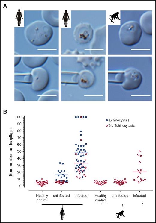 Figure 2. Comparison of the deformability of P knowlesi iRBCs from humans and M fascicularis. (A) Human iRBCs (first two columns) and M fascicularis iRBCs (last column) before (upper row) and after (lower row) micropipette aspiration. (B) Deformability, as measured by micropipette aspiration, of iRBCs and uRBCs from P knowlesi–infected humans and M fascicularis monkeys compared with healthy human and monkey controls. An increase in MSM reflects a decrease in deformability. Scale bar = 5 μm.