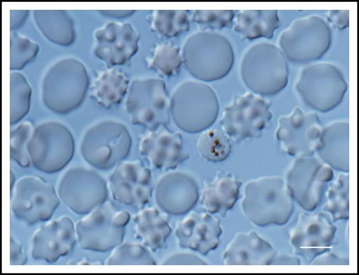 Figure 3. Representative photograph of RBCs from a patient with severe knowlesi malaria. The unstained sample was observed on a heated stage (∼37°C) in isotonic saline. Although most of the RBCs observed are noninfected, 1 infected RBC containing a mature parasite with hemazoin can be seen. Many of the RBCs are echinocytes. Scale bar = 5 μm.
