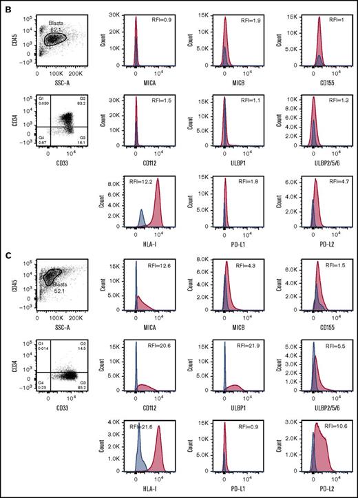 NKRLs are variably expressed by AML blasts. The expression of 6 activating (MICA, MICB, CD155, CD112, ULBP1, and ULBP2/5/6) and 3 inhibitory (PD-L1, PD-L2, and HLA class I) NKRLs was detected by flow cytometry on cryopreserved bone marrow blasts harvested from 66 patients with a new diagnosis of AML. Side scatter (SSC-A) and CD45 were used to gate the blast population. CD33 and CD34 were used as additional markers of disease. The RFI was calculated for each ligand as follows: mean fluorescence intensity (MFI) of the ligand/MFI of the unstained control. (A) NKRL RFIs calculated and plotted for all 66 patients. Each replicate is shown; black horizontal line corresponds to median values. (B) Representative plots of a patient expressing only inhibitory ligands (HLA-I and PD-L2). (C) Representative plots of a patient with high expression of both activating and inhibitory NKRLs. (D) Representative plots of a patient with a double blast population (CD33posCD34pos and CD33posCD34dim), where the expression of ULBP1 was strikingly different: the CD33posCD34pos blasts expressed low levels of ULBP1 (RFI = 5.5), whereas the activating ligand was highly expressed on CD33posCD34dim cells (RFI = 69.5). Blue histograms correspond to unstained control MFI; red histograms correspond to NKRL MFI. (E) An RFI score ranging from 0 to 2 was calculated for each ligand as follows: (1) samples with RFI <2 (ie, less than twofold increase of median fluorescence above background) were considered negative and assigned score 0; (2) Samples with an RFI value between 2 and the III quartile were assigned score 1; (3) Samples with RFI equal to or above the III quartile were assigned score 2. Panel E represents the distribution of patients according to the RFI score for each NKRL.