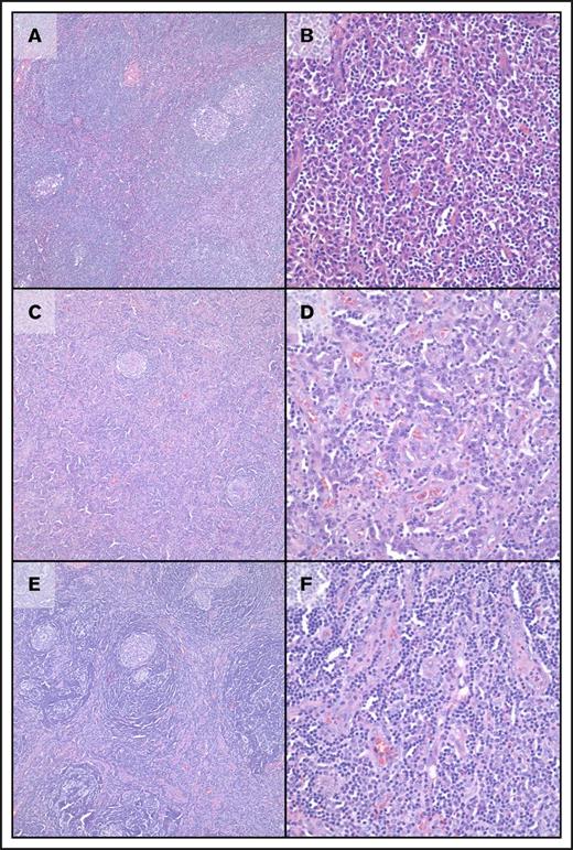 Figure 2. Morphologic features of cases of UCD and MCD with genetic abnormalities. (A-B) Case 3, HHV8−/iMCD with plasmacytic histology. At low-power magnification, regressed follicles are seen with onion skinning of mantle zones and “twinning” of follicles; increased plasma cells are clearly seen in interfollicular regions with mild vascularity. (C-D) Case 5, UCD-MV. At low-power magnification, regressed follicles are seen with onion skinning of mantle zones along with increased vascularity in interfollicular regions. At high-power magnification, increased plasma cells are clearly seen along with increased vascularity. (E-F) Case 14, UCD-HVV. At low-power magnification, regressed follicles are seen with prominent onion skinning of mantle zones and “twinning” of follicles. At high-power magnification, increased vascularity is present without increased plasma cells. In all panels, images on cases are taken in sequence at ×100 (left) and ×400 (right) magnification; all images are from hematoxylin and eosin–stained slides.