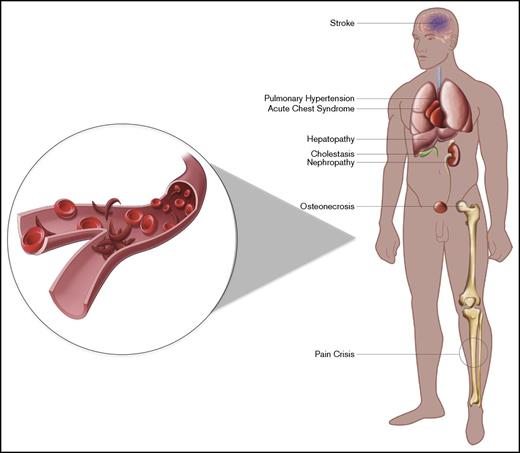 Figure 1. Manifestations of SCD. The manifestations of SCD vary among patients. Patients may develop end-organ damage of the kidney, liver, and lungs, which would be potential targets for dual transplantation. Illustration by Evan Dailey, Rowan University.