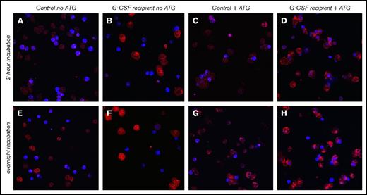 Figure 4. Confocal microscopy confirms higher cytotoxicity through ATG-mediated phagocytosis by neutrophils after G-CSF treatment. Neutrophils were obtained from a healthy donor who received 10 mg/kg Filgrastim for 5 days and from a healthy donor who served as control. Neutrophils were incubated with CD14− allogeneic PBMCs in the absence or presence of 20 μg/mL ATG for 2 hours or overnight. Neutrophils were stained with CD64− APC (red), and target cells were CTV+ labeled (blue) for confocal microscopy visualization. Pictures were taken with same Z-resolution (in 1 slice). Original magnification ×65. (A,E) Control neutrophils and target cells without ATG, incubated for 2 hours (A) or overnight (E). (B,F) Neutrophils from G-CSF recipient and target cells without ATG, incubated for 2 hours (B) or overnight (F). (C,G) Control neutrophils and target cells with ATG, incubated for 2 hours (C) or overnight (G). (D,H) Neutrophils from G-CSF recipient and target cells with ATG, incubated for 2 hours (D) or overnight (H). For neutrophils from the G-CSF recipient, shown are target cells within neutrophils. Z-stack analyses were applied to ensure target cells were contained within neutrophils.
