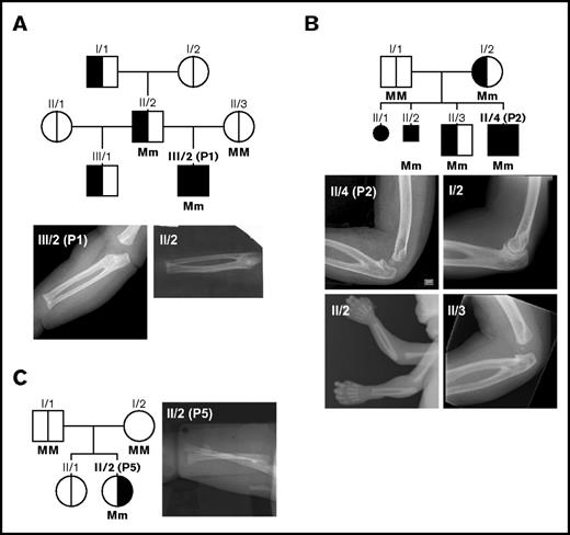 Figure 2. Pedigrees and radiographs of upper limbs of patients P1, P2, and P5. Pedigrees of the familial cases P1 (A) and P2 (B) showing the occurrence of RUS (left area black) and CAMT/congenital aplastic anemia (right area black); radiographs of the upper limbs demonstrating proximal RUS in family members (small symbols indicate stillborn fetuses). (C) Pedigree and radiograph of sporadic case P5; radiograph of the forearm of P5 in pronated state, ruling out RUS. Genotype is included for the analyzed individuals of the pedigrees. M, wild-type allele; m, mutated allele.