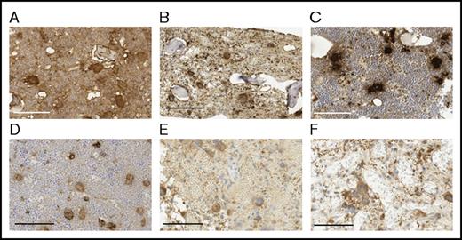 Figure 6. Effect of ODSH on intramedullary PF4 levels. (A) hPF4+/Cxcl4−/− marrow 48 hours after irradiation stained with anti-hPF4 antibody. (B) Same as panel A, but for hPF4+/Cxcl4−/− marrow treated with a total of 75 mg/kg ODSH. (C) As in panel A, but for WT animal without irradiation. (D) As in panel B, but for WT animal treated with ODSH without irradiation. (E) Same as panel C, but 48 hours after irradiation in a WT animal (treated with PBS). (F) Same as panel D, but 48 hours after irradiation in a WT animal treated with ODSH. For all panels, scale bar = 100 µm; immunohistochemical stain and counterstained with hematoxylin.