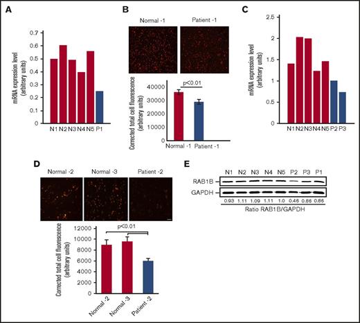 Figure 1. RAB1B expression in platelets from the patients with RUNX1 haplodeficiency and healthy control subjects. (A) Platelets RAB1B mRNA levels in the index (P1) patient and 5 normal subjects (N1-N5) by quantitative PCR. Shown are mRNA levels normalized to GAPDH. (B) Immunofluorescence studies of platelet RAB1B expression in the index patient P1 and a normal subject. Platelets were labeled with RAB1B polyclonal antibody, detected with fluorescein isothiocyanate (pseudocolored red)–conjugated secondary antibody, and imaged on a Nikon E1000 microscope. Corrected total cell immunofluorescence is shown ± SEM. (C) Platelet RAB1B mRNA in 2 siblings (P2 and P3) from a second family with RUNX1 mutation and 5 normal subjects (N1-N5). (D) Platelet RAB1B immunofluorescence in patient P2 and 2 normal subjects. Bar, 10 μm (scale also applies to panel B). Corrected total cellular fluorescence is shown ± SEM. The P values represent comparisons of the patient with each of the control subjects. (E) Platelet RAB1B by immunoblotting in 3 patients (P1-P3) and 5 healthy subjects (N1-N5). Also shown is the ratio of RAB1B to GAPDH.