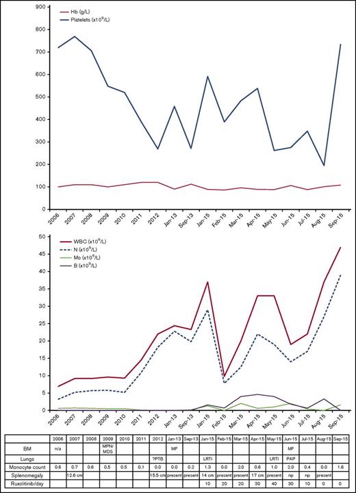 Figure 1. Blood and BM investigations and clinical course (2006-2015). Progress of hemoglobin (Hb) and platelet count (top). Progress of white blood cell count (WBC), neutrophils (N), monocytes (Mo), and blasts (B) in the blood (middle). Table listing diagnostic details, absolute monocyte counts, and clinical events (bottom). LRTI, lower respiratory tract infection; MF, myelofibrosis.