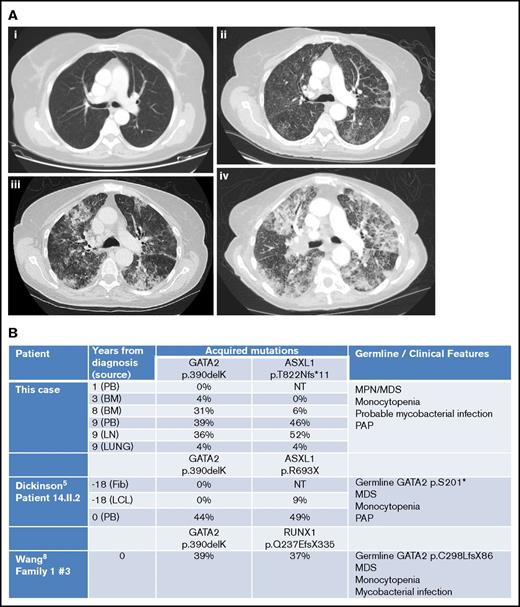 Figure 2. Imaging and molecular investigations. (A) Serial computed tomography chest images (2007-2015). (i) June 2007: no respiratory symptoms. Normal imaging. (ii) January 2015: no respiratory symptoms but evidence of progressive MPN/MDS. Early interstitial changes are present. (iii) June 2015: cough and breathlessness. Progressive interstitial changes plus air space shadowing are present. (iv) September 2015: respiratory failure secondary to PAP. “Crazy paving” changes plus consolidation characteristic of PAP visible. (B) Comparison of somatically acquired c.1168_1170delAAG p.390delK GATA2 mutations. Three patients have been reported with somatically acquired p.390delK mutation in GATA2. Germ line mutations in GATA2 and other cooperating mutations in ASXL1 or RUNX1 were also present in two previous cases. Fib, fibroblast; LCL, lymphoid cell line; LN, lymph node; NT, not tested; PB, peripheral blood.
