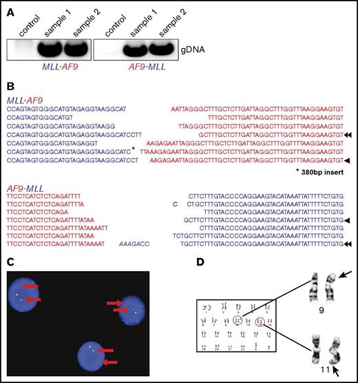 Figure 1. Molecular and cytogenetic features of MLL-AF9–rearranged cells induced by genome editing. (A) Representative PCR to detect MLL-AF9 (left) and AF9-MLL (right) translocation breakpoints in gene-edited cells at day 27 of culture (samples 1 and 2). (B) Data shown are a composite alignment of PCR products from multiple experiments (days 7-14 of culture) showing a variety of distinct translocations. Arrowheads indicate the sequence of long-term–survived clones. (C) FISH analysis using an MLL break-apart probe was performed on genome-edited cells maintained in culture for over 50 days. A representative image is shown. Arrows indicate the split signals of the break-apart probe indicating MLL translocation. (D) Representative metaphase chromosomes from karyotype analysis of genome-edited cells shows a balanced t(9;11) chromosomal translocation.