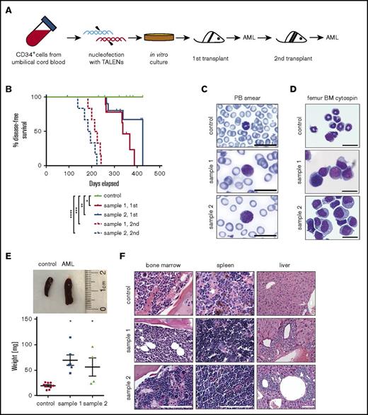 Figure 6. Genome-edited cells with t(9;11) chromosomal translocations induce AML. (A) Experimental scheme for induction of AML by genome-edited cells following transplantation in sublethally irradiated NSG recipient mice after 98 days of in vitro culture. (B) Disease-free survival of transplanted mice; *P < .009 (control vs sample 1, 1st), **P < .07 (control vs sample 2, 1st), ***P < .0001 (control vs sample 1, 2nd), and ****P < .0001 (control vs sample 2, 2nd) by log-rank test. (C-D) May-Grünwald-Giemsa staining shows blast cells in peripheral blood (PB) smear (C) and monomorphic bone marrow (BM) cells (D). Scale bar, 20 μm. (E) Increased spleen size (top) and weight (bottom) of leukemic mice compared with control; *P < .01. (F) Hematoxylin and eosin–stained sections of bone marrow, spleen, and liver. Scale bar, 100 μm.