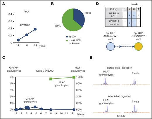 Figure 3. The clonal architecture of HLA-A3101−granulocytes in case 2. (A) Changes in the VAF of the DNMT3A mutation during the last 6-year study (7-12 years after the diagnosis). (B) The composition of HLA-A3101− granulocytes, as revealed by HLA-A allelic sequencing. 6pLOH−A*31:01mut− cells accounted for 64% of the total HLA-A3101− granulocytes. (C) The chronological changes in the GPI-AP− granulocytes and HLA-A3101− granulocytes. (D) The genotypes of 4 colonies derived from PB non-T–nonadherent cells. Whether individual colonies are positive or negative for the amplified product of A*31:01 and mutated DNMT3A (top panel) and their summary (bottom panel) are shown. (E) The results of HUMARA for HLA-A3101− granulocytes. The S score was as low as 1.17, and was in line with the results of HLA-A–allelic sequencing, which showed the presence of >2 HLA-A3101− HSPC clones. NSAA, nonsevere aplastic anemia.