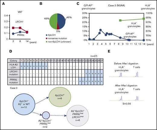 Figure 4. The clonal architecture of the HLA-A2−granulocytes in case 3. (A) The changes in the VAF of LRCH1- and PRR5L-mutant clones during the 12-year observation period. (B) The clonal composition of HLA− granulocytes, as revealed by HLA-A–allelic sequencing. An HLA-A*02:06-mutant clone (nonsense mutation) accounted for 5% of HLA-A2− granulocytes. (C) The chronological changes in the percentage of GPI-AP− granulocytes and HLA-A2− granulocytes. (D) The genotypes of 27 colonies derived from PB non-T–nonadherent cells. Whether individual colonies are positive or negative for the amplified product of A*02:06, mutated LRCH1, and mutated PRR5L sequences (top panel) and the summary of the colony genotypes (bottom panel) are shown. (E) The results of HUMARA. The relatively low S score (0.56), of the HLA− granulocytes was compatible with the results of HLA-A*02:06 sequencing, which showed triclonality.