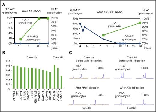 Figure 5. Clonal hematopoiesis revealed by WES in 2 cases. (A) The chronological changes of HLA− granulocytes and GPI-AP− granulocytes in case 12 (left) and case 15 (right). In case 15, which involved a patient who had been diagnosed with hemolytic PNH, the spontaneous resolution of PNH was observed; however, clonal hematopoiesis was subsequently developed by an HLA-A31− HSPC. (B) The VAFs of each gene mutation detected in case 12 (left) and case 15 (right). (C) The results of HUMARA for HLA-A2− granulocytes of case 12 (left) and HLA-A31− granulocytes of case 15 (right). Extremely high (2.16 in case 12) and low (0.68 in case 15) S scores indicate the presence of apparent clonal hematopoiesis in both patients. VSAA, very severe aplastic anemia.