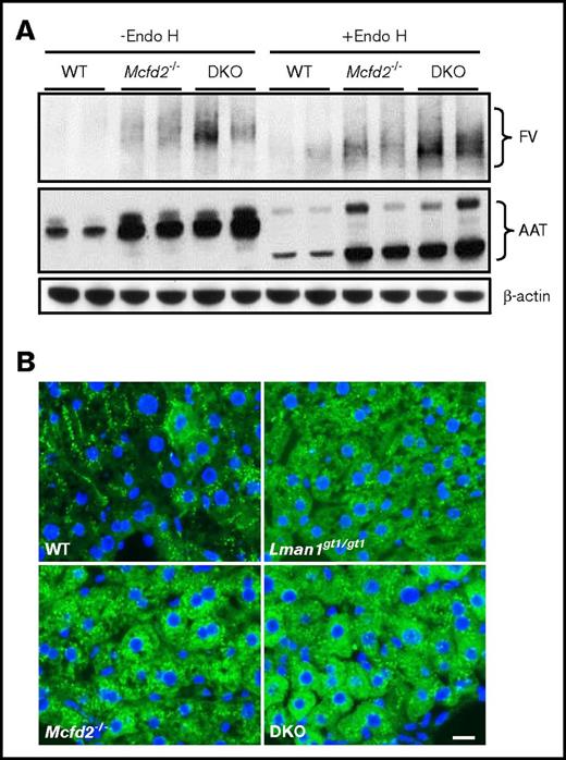 Figure 4. Endo H sensitivity of intracellular FV and AAT in WT, Lman1gt1/gt1, Mcfd2−/−, and DKO mice. (A) Liver lysates of male WT, Mcfd2−/−, and DKO mice were treated or not with endo H and analyzed by immunoblotting with anti-FV, anti-AAT, and anti–β-actin antibodies. (B) Immunofluorescence staining of frozen sections of WT, Lman1gt1/gt1, Mcfd2−/−, and DKO liver for AAT. Identical staining protocols were performed simultaneously for all samples. Scale bar, 25 μm.