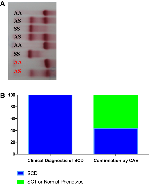 Confirmation of clinical diagnosis of SCD. (a) CAE of hemolysates. Patients are shown in black and hemolysate controls are shown in red. (b) Comparative results between clinical diagnosis of SCD and confirmation of SCD, SCT, or normal phenotype by CAE.