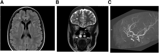 MRI (A) FLAIR (axial) and (B) T2W (coronal). Brain images from a 15-year-old female with SCA without neurologic complications according to history from parents and child. SCI seen in 2 planes measuring .3 mm in right frontal lobe deep white matter. (C) MRA: right and left cavernous ICA stenosis.