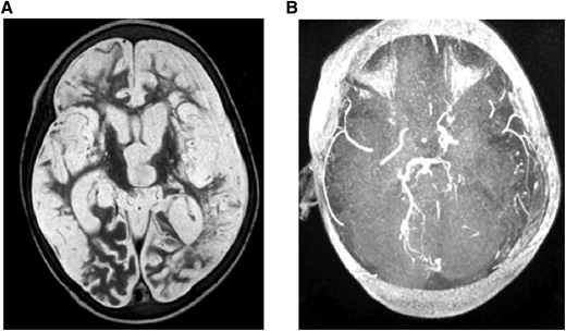 (A) MRI: T2W (axial) and (B) MRA. Brain images from a 7-year-old quadriplegic boy showing (A) global cerebral infarction and (B) occlusion of both terminal internal carotid arteries and small left posterior cerebral artery but no moyamoya collaterals.