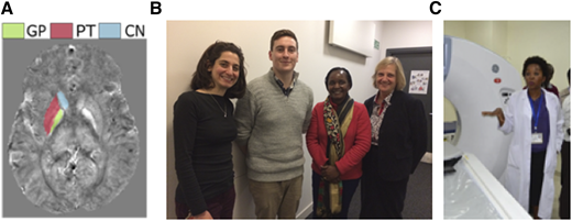 (A) Susceptibility mapping on MRI for brain iron measurement, (B) brain iron measurements techniques team, and (C) an imaging machine and the head of the MUHAS Radiology Department.