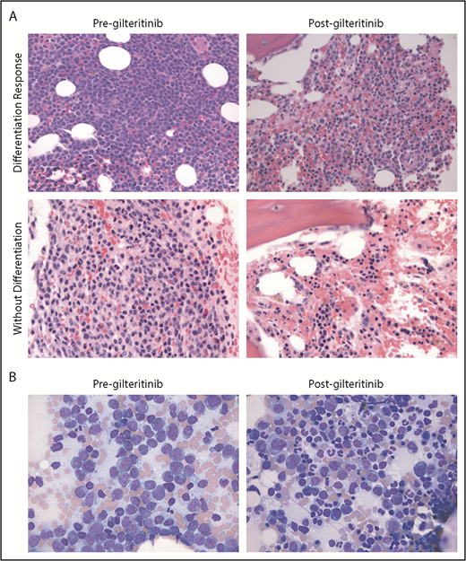 Figure 1. Gilteritinib induces 2 distinct morphologic patterns of response in R/R FLT3mut+ AML: responses with and without differentiation. (A) Representative core biopsy marrow specimens from prior to initiation of gilteritinib and at the time of best marrow response show the effect of gilteritinib on total marrow cellularity in a subject with a differentiation response (top row) and in a subject with response without differentiation (second row). Differentiation responses are generally characterized by persistently hypercellular marrows, while responses without differentiation are associated with a reduction in total marrow cellularity. The core biopsy specimens are hematoxylin and eosin–stained at 400× objective magnification. (B) Bone marrow aspirate morphology at baseline and after treatment with gilteritinib in a subject with a differentiation response shows marked granulocytic hyperplasia with a left shift. The aspirate smears are Wright-Giemsa–stained at 500× objective magnification (oil immersion).