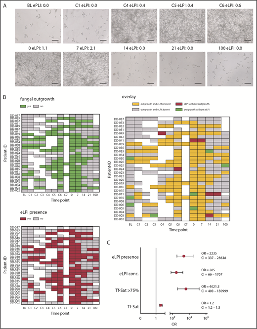 Figure 1. Presence of enhanced labile plasma iron in sera of patients undergoing allogeneic hematopoietic stem cell transplantation determines AFU outgrowth. Human serum samples of 29 representative ALLIVE participants, which were collected during the consecutive phases of allogeneic hematopoietic stem cell transplantation (HSCT) were screened for AFU outgrowth. AFU spores (5 × 104/mL) were seeded in RPMI containing 10% complement-depleted patient serum. Outgrowth was determined after 48 hours by microscopic examination. (A) Microscopy images showing fungal cultures of a representative patient (DD-15) with eLPI serum concentrations as indicated (original magnification ×20; bars represent 30 µm). (B) Heat map representation of fungal outgrowth (upper left), eLPI presence (lower), and their overlay (right) of patients analyzed here at all times (green, fungal outgrowth; red, eLPI present; yellow, both fungal outgrowth and eLPI present; gray, fungal growth and eLPI absent; white, sample not available). (C) Relative probability of AFU outgrowth in sera of patients depending on iron-related parameters (eLPI concentration, eLPI presence, Tf-Sat, and Tf-Sat > 75%. The graph depicts ORs ± 95% CIs for probability of fungal outgrowth. Statistical significance was assessed using a multiparameter logistic regression model for the outgrowth response variable (no fungal growth vs fungal outgrowth). 0, day of transplantation; 7-100, days 7-100 after transplantation; BL, baseline; C1-7, conditioning days 1-7.