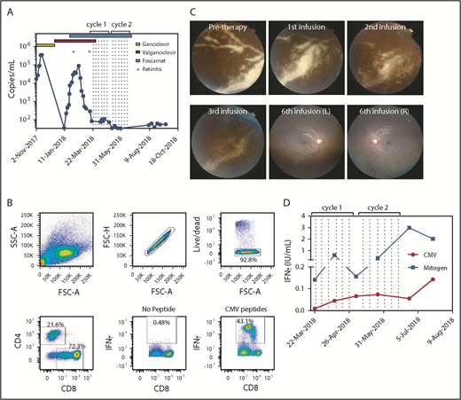 Figure 1. Cellular immunotherapy for CMV-associated retinitis. (A) CMV viral titer during the course of treatment overlaid with antiviral regimens and times for detection of retinitis. Dotted lines represent the times of T-cell infusion. (B) Flow cytometric analysis showing the characteristics of the donor-derived CMV-specific T-cell therapy. The production of IFN-γ was determined using a standard intracellular cytokine assay. (C) The top left panel represents fundus photography showing severe active retinitis and periphlebitis in the right eye inferotemporal quadrant (pretherapy). Progressive resolution of retinitis is shown after 1, 2, and 3 CMV-specific T-cell infusions. The right hand panels represent wide-field fundus photographs showing significantly improved retinitis after 6 T-cell infusions. (D) Immunological reconstitution after ACT was assessed using the QuantiFERON-CMV assay. Data represent IFN-γ (IU/mL) titers after stimulation with either the CMV peptides or mitogen and subtracting the no-antigen control. Dotted lines represent the times of T-cell infusions.