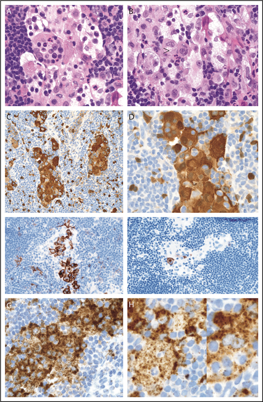 Figure 1. LN with mixed RDD disease and LCH in the sinuses, BRAF-V600E mutated. (A-B) Sinus expansion with large RDD histiocytes with emperipolesis and inconspicuously intermixed smaller LCH histiocytes with nuclear groves and eosinophilic cytoplasm (arrowhead) (hematoxylin and eosin stain; original magnification ×1000). (C-D) RDD histiocytes and smaller intermixed LCH cells with nuclear and cytoplasmic S100 staining (immunostain; original magnification ×400 and ×1000, respectively). (E) Sinus LCH disease with clusters of plump cells with CD1a surface and cytoplasmic dot staining (immunostain; original magnification ×400). (F) Low variable Langerin (immunostain; original magnification ×400). (G) Strong BRAF (VE1) staining was seen in both histiocyte cell types (immunostain; original magnification ×1000). (H) Two selected magnified RDD cells with emperipolesis and VE1 granular cytoplasmic staining (immunostain; original magnification ×1000).