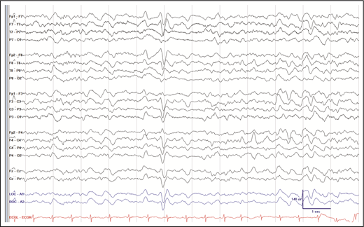 Figure 1. Snapshot of patient’s electroencephalogram from suspected ATO toxicity. There is mild-to-moderate slowing and frequent triphasics without frank seizures or focal epileptiform activity, suggesting toxic-metabolic etiology.