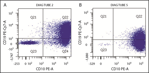 Figure 2. Change in leukemic blast expression of CD19 after selective pressure of blinatumomab. (A) Multicolor flow cytometric analysis of leukemia blasts after conventional chemotherapy exposure demonstrates predominantly normal CD19 expression. (B) After exposure to the CD19-directed immunotherapeutic agent blinatumomab, there is a large CD19− blast population. This correlates with the progression of disease seen during administration of blinatumomab, possibly as a result of hypermutation of the malignant clone.
