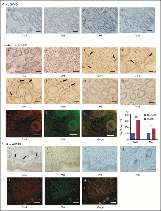 Figure 2. Gas6 and Mer expression in aGVHD lesions of the large intestine and skin. (Aa-d) IHC of Gas6, Mer, Axl, and Tyro3 in the intestinal tissues of patients without aGVHD was performed. Analysis of the IHC results indicated that little to no expression of Gas6, Mer, Axl, or Tyro3 was observed in the large intestine of patients with negative histology for aGVHD. Scale bars represent 10 µm. Original magnification ×200. (Ba-b) CD3-positive infiltrating T lymphocytes were markedly increased in aGVHD lesions of the large intestine. Scale bars represent 10 µm. Original magnification ×200. (Bc-h) Gas6 and Mer were significantly upregulated in the aGVHD lesions of the large intestine, whereas little to no Axl or Tyro3 was detectable. Immunohistochemical stain for Gas6, Mer, Axl, or Tyro3. Arrows indicate Gas6 and Mer expression in aGVHD lesions of the large intestine. Scale bars represent 10 µm. Original magnification ×200. (Bi-k) Fluorescent IHC of Gas6 and Mer in aGVHD lesions of the large intestine was performed. Scale bars represent 10 µm. Original magnification ×200. (Bl) The statistical analysis revealed that the expression of Gas6 and Mer was increased in the aGVHD lesions of the large intestine compared with patients with no such lesions. We measured the intensity of Gas6 and Mer expression levels by color densitometry, using image J. Results are shown as mean ± SD of statistical analyses from 4 separate experiments. **P < .01, *P < .05. (Ca-d) IHC of Gas6, Mer, Axl, and Tyro3 in the aGVHD lesions of the skin was performed. Scale bars represent 50 µm. Original magnification ×200. (Ce-g) Fluorescent IHC of Gas6 and Mer in aGVHD lesions of the skin was performed. Scale bars represent 50 µm. Original magnification ×200.