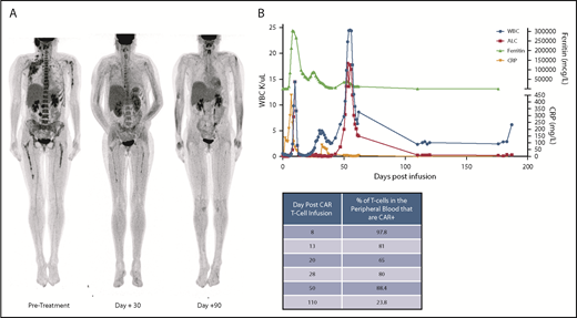 Figure 1. Clinical course. (A) FDG–positron emission tomography (PET) scan demonstrating significant extramedullary disease burden at pretreatment, followed by clinical response at day +30, and subsequent full resolution of any PET-avid disease at day +90. Subject was MRD− in the bone marrow by the day +30 evaluation and remained MRD− at the subsequent time points. (B) Clinical timeline with relevant laboratory findings. During the initial CRS, patient had a concurrent rise in CRP and ferritin which coincided with the initial WBC peak. During the second expansion phase, the patient remained clinically well without any fevers and had only modest increase in C-reactive protein (CRP) and ferritin, but with an even higher WBC than with the initial expansion. Concurrent table demonstrates the % of T cells which were CAR+ in the peripheral blood at the various timepoints.