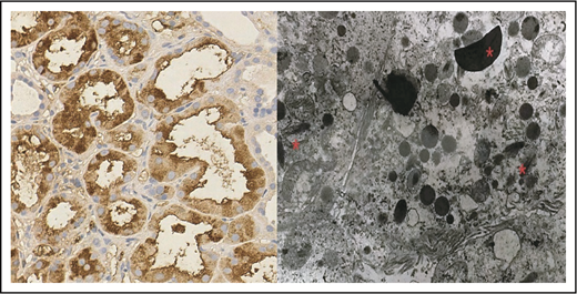 Figure 4. Features of LCPT. IHC stained strongly positive for κ light chain in proximal tubules; λ (data not shown) was negative (original magnification ×400; DAB + Harris’s hematoxylin stain; left panel). TE microscopy image shows rhomboid crystal inclusions (*) in keeping with light chain proximal tubulopathy (original magnification ×4000; right panel).