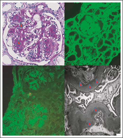 Figure 5. Features of an LCDD. Glomerulus with nodular mesangial expansion (arrowheads; original magnification ×400; PAS; upper left panel). IF showed strong positivity for κ light chain (upper right panel); compare with negative λ (lower left panel) in glomerular and tubular basement membranes and mesangial nodules, in keeping with a κ LCDD (original magnification ×200; fluorescein isothiocyanate). TE microscopy image shows powdery electron-dense deposits along basement membranes (arrowheads) in keeping with LCDD (original magnification ×6000, fluorescein isothiocyanate; lower right panel).